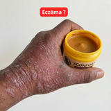 Fini les Démangeaisons : Crème Apaisante à Action Rapide